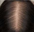 Low Hair Density