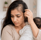 Postpartum Hair Loss