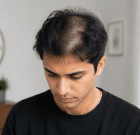 Rapid Hair Loss