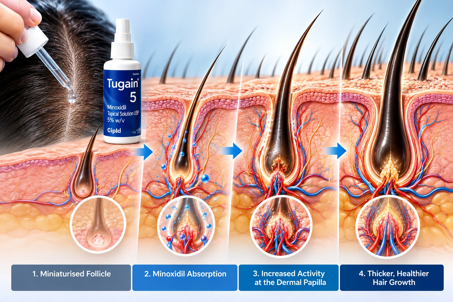 Medical illustration showing topical minoxidil application to the scalp, absorption near hair follicles and its potential effects on follicle activity and hair growth.