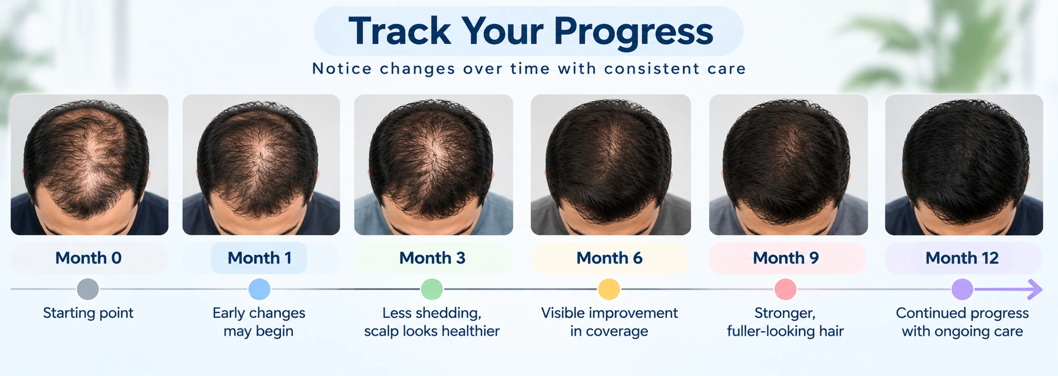 Month-by-month male hair loss progress tracking visual showing how hair and scalp changes can be documented over time.