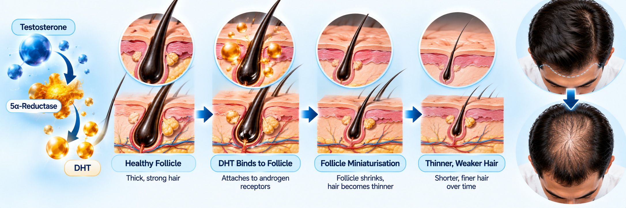 How DHT contributes to follicle miniaturisation in male pattern baldness