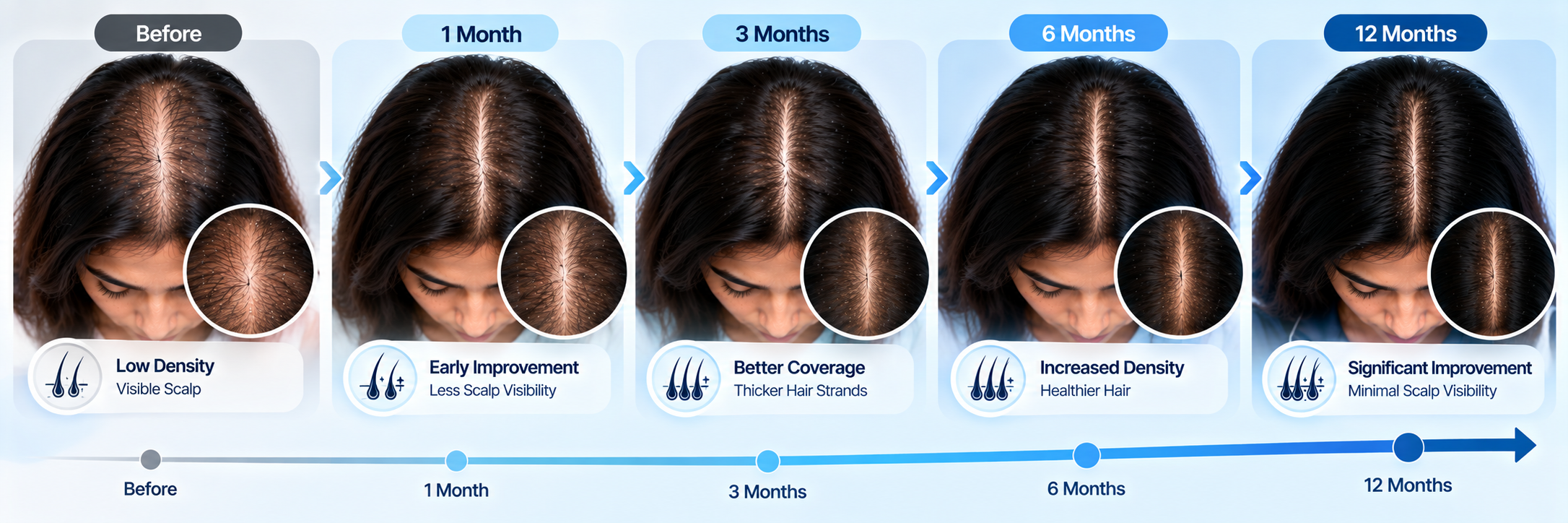 Diffuse thinning progress tracking visual showing overall hair density changes from baseline through 1, 3, 6 and 12 months.