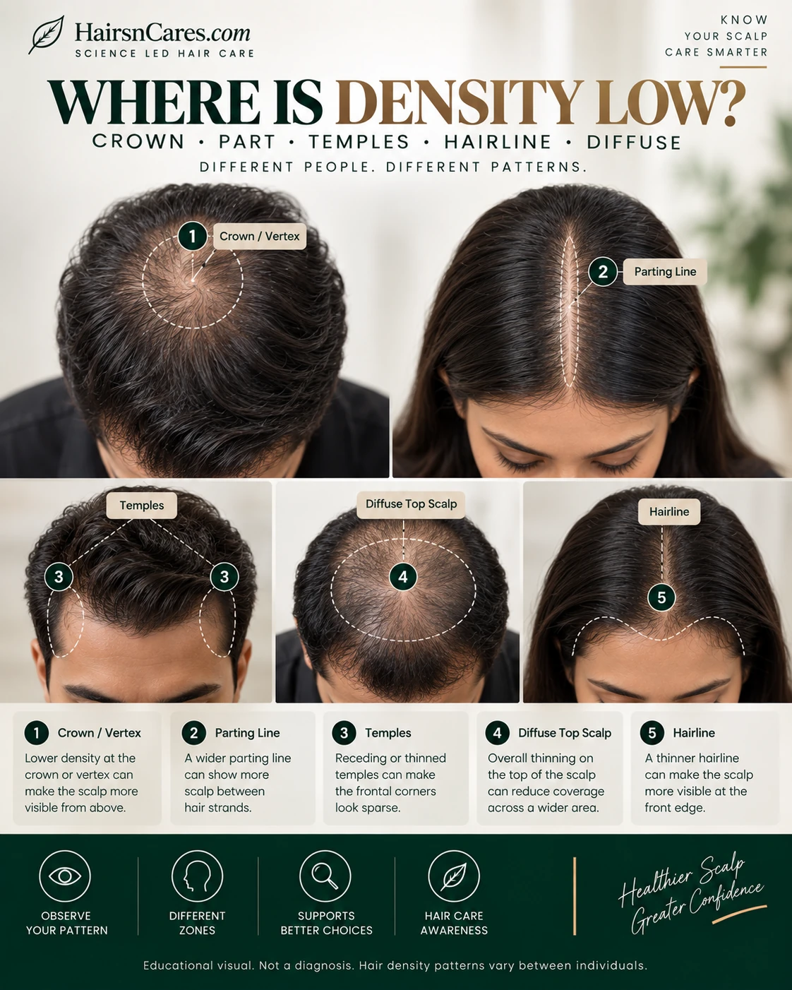 Low density hair zone mapping showing crown vertex parting line temples diffuse top scalp and hairline