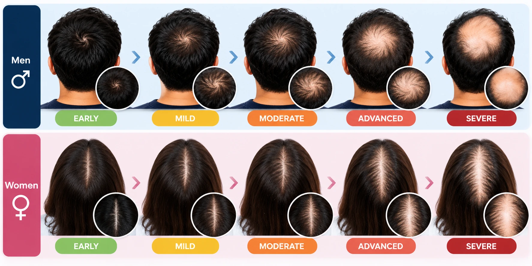 Crown Thinning Severity & Stages Visual guide showing early, mild, moderate, advanced, and severe stages of crown thinning in men and women.
