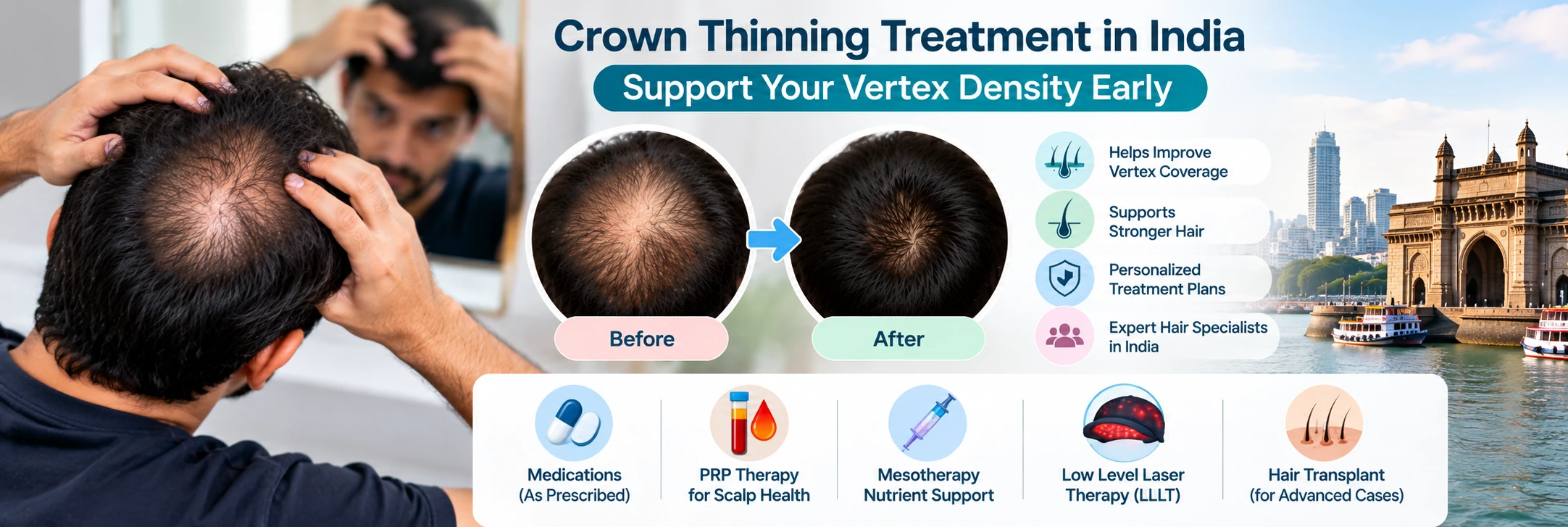 Crown Thinning Treatment in India – Support Vertex Density Early Crown thinning treatment in India showing male vertex hair loss, crown density comparison and treatment options for early-stage crown thinning.