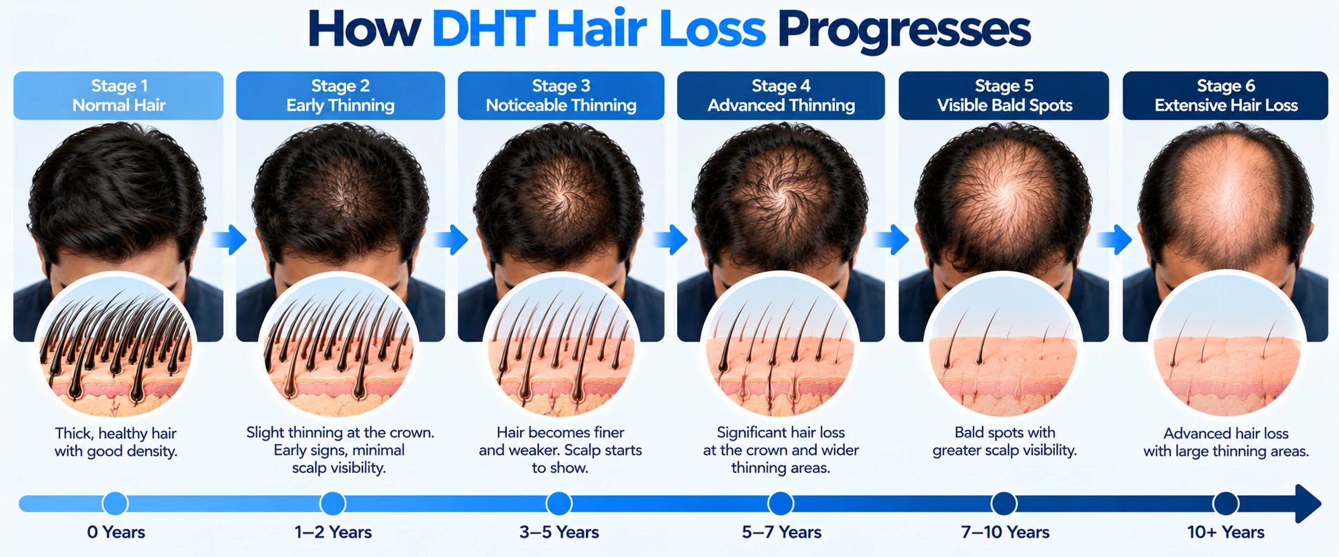 How DHT Hair Loss Progresses DHT hair loss progression timeline showing early thinning, noticeable crown thinning, bald spots, and advanced hair loss stages.