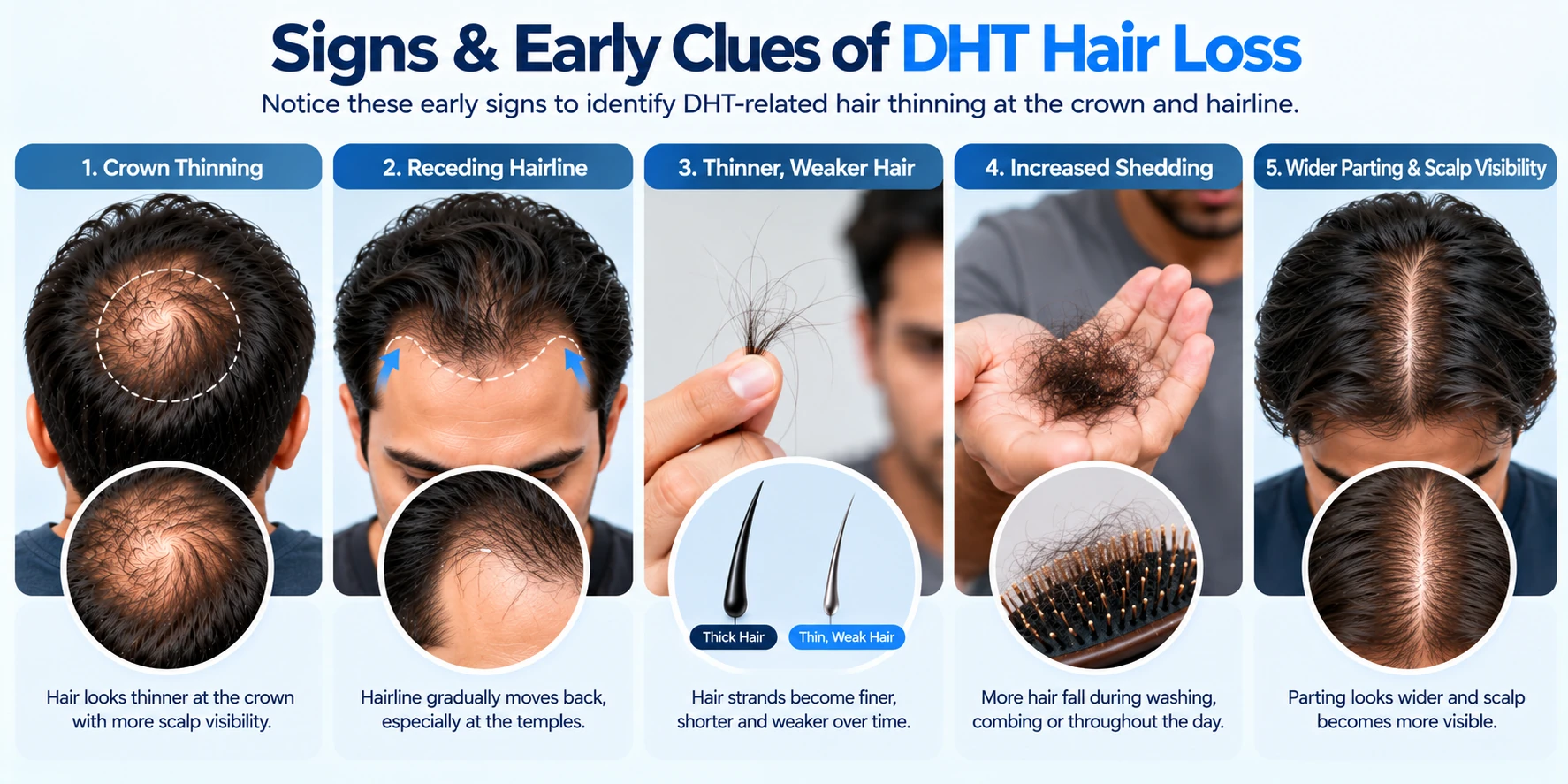Signs & Early Clues of DHT Hair Loss Early signs of DHT hair loss showing crown thinning, receding hairline, thinner hair, increased shedding, and greater scalp visibility.