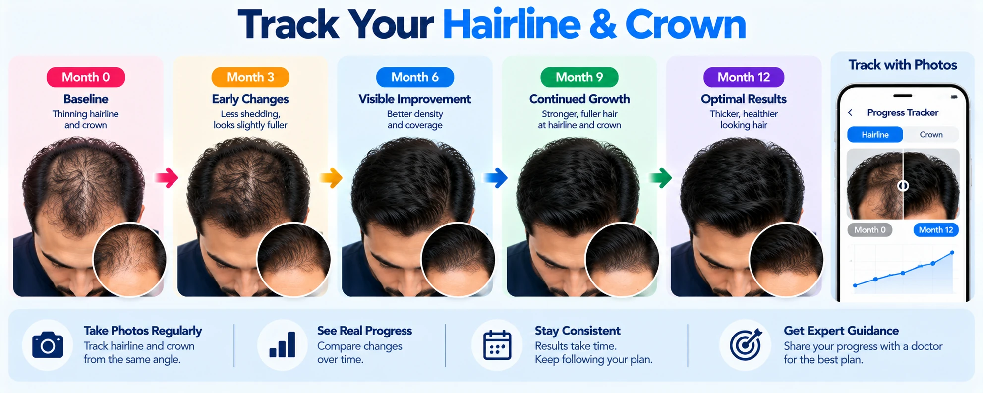 Track Your Hairline & Crown Progress Hairline and crown progress tracking timeline showing changes in hair density from baseline through 12 months using consistent scalp photos.