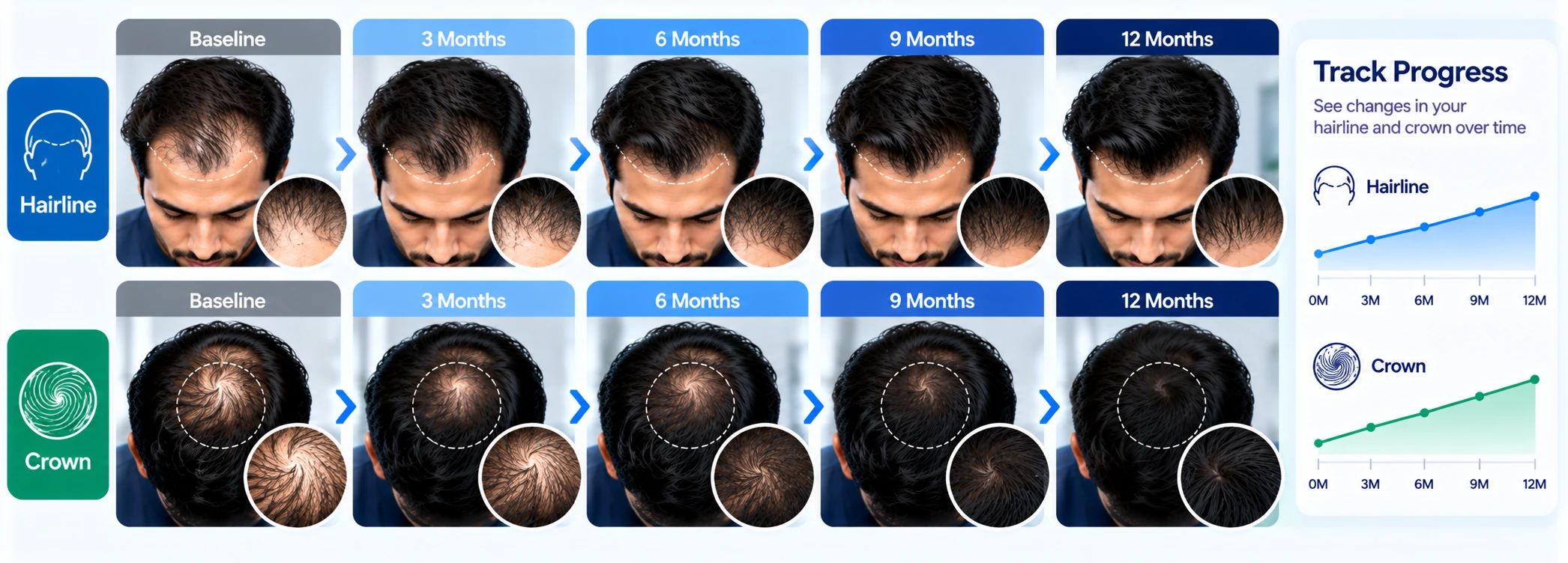 Track Your Hairline & Crown Progress Hairline and crown progress tracking visual comparing hair density from baseline to 12 months with consistent hair loss progress photos.
