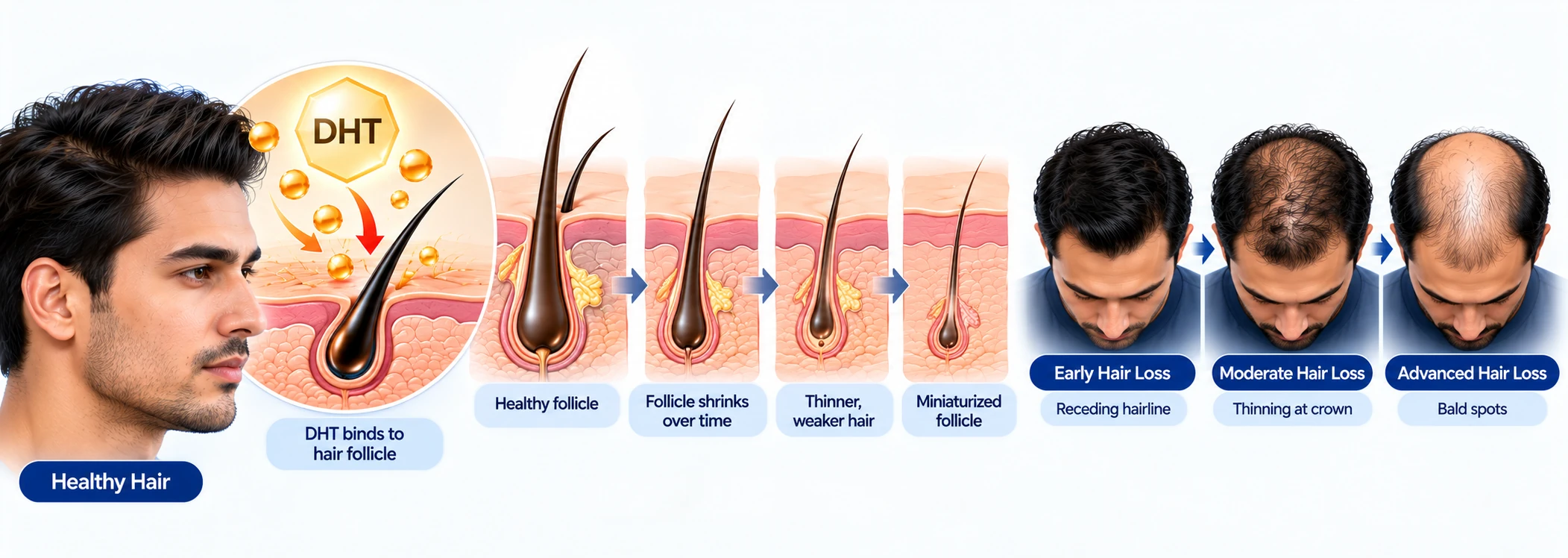 What Male Pattern Baldness Really Is Male pattern baldness explainer showing DHT binding to hair follicles, follicle miniaturization, receding hairline, crown thinning, and advanced hair loss.