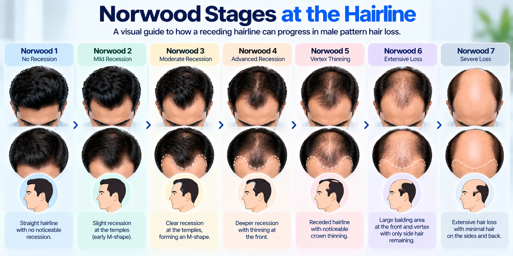 Norwood Stages for Receding Hairline Norwood stages showing progression of a receding hairline from mild temple recession to advanced male pattern hair loss.