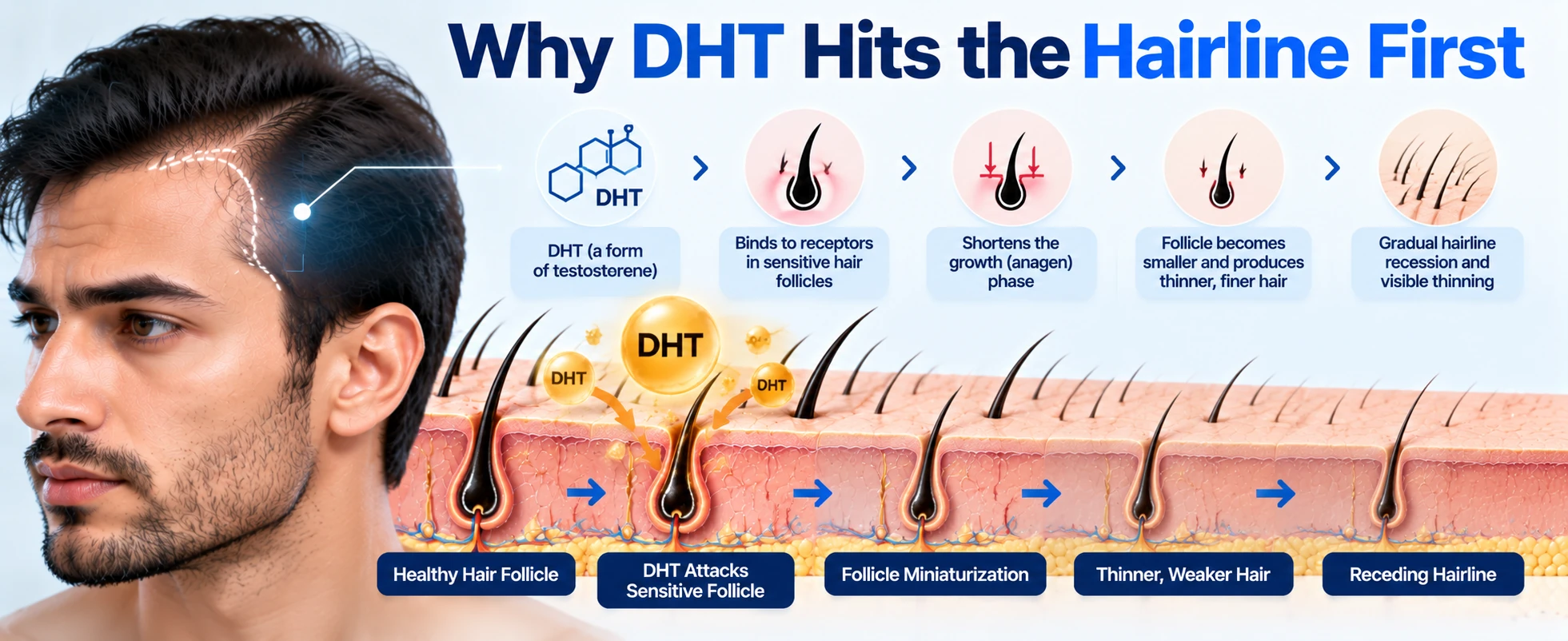 Why DHT Hits the Hairline First Diagram showing how DHT affects sensitive hair follicles at the hairline, causing follicle miniaturization, thinner hair, and gradual hairline recession.